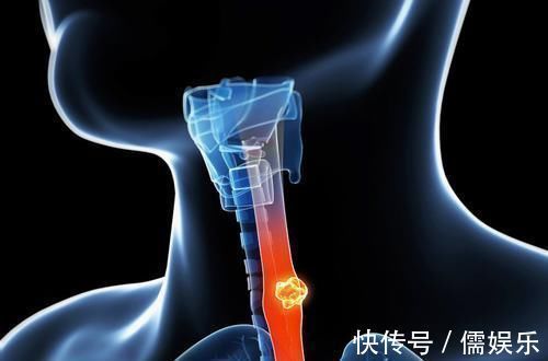 手术|如果不幸患了癌,是不是只要动手术切除就可以了,没那么简单