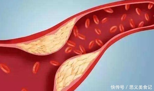 建议中老年，若不缺钱多吃这2物，稳血脂通血管，还不贵