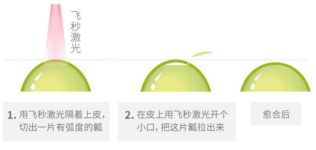 角膜|近视手术该不该做?怎么选?一文给你讲清楚