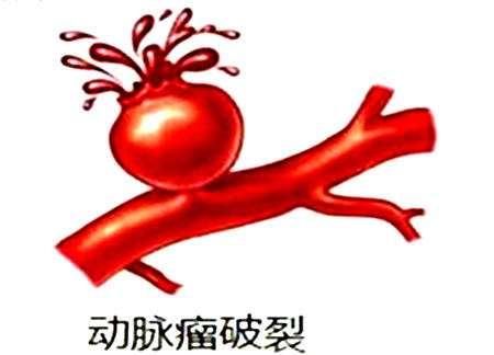 脑部的这个如何“炸弹”？那应该如何预防它呢？