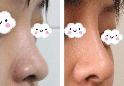 鼻部整形真的安全吗？假体隆鼻材料硅胶和膨体哪个更自然持久？