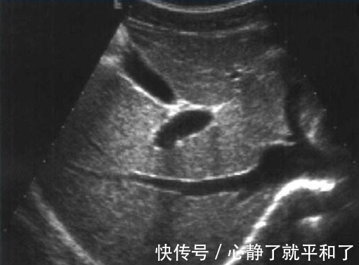 体检|为什么体检结果一切正常,4天后查出癌症晚期?