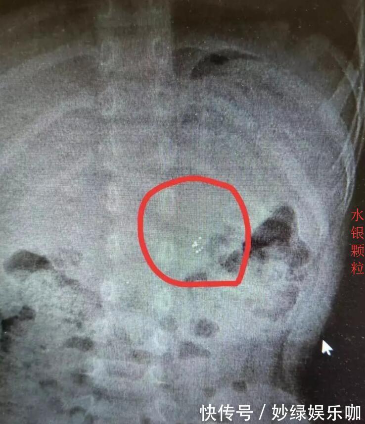 医院|三岁女儿误吞水银,奶奶坚持吃完韭菜再去医院,医生点赞:高明