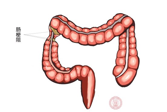 腸梗阻快速排氣妙招有哪些