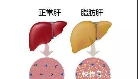 常吃|患有脂肪肝的人，常吃3种食物，或能帮助肝脏排毒，建议了解下