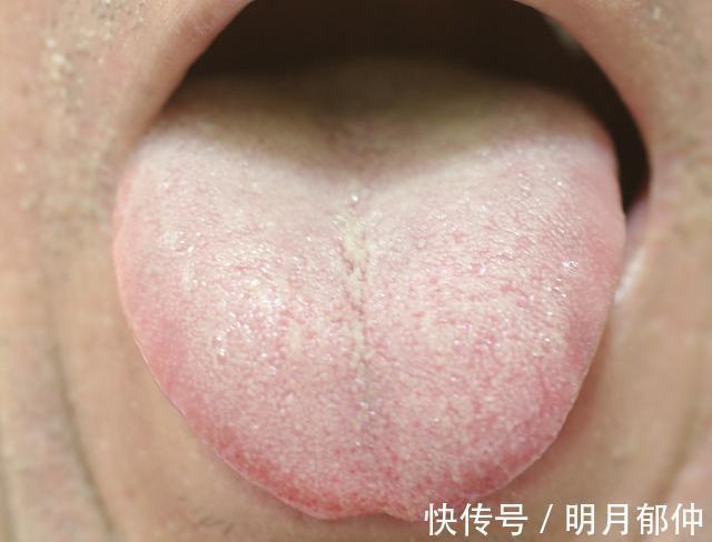 青紫|身体里有肿瘤，舌头上也会有表现！出现3种异象需小心