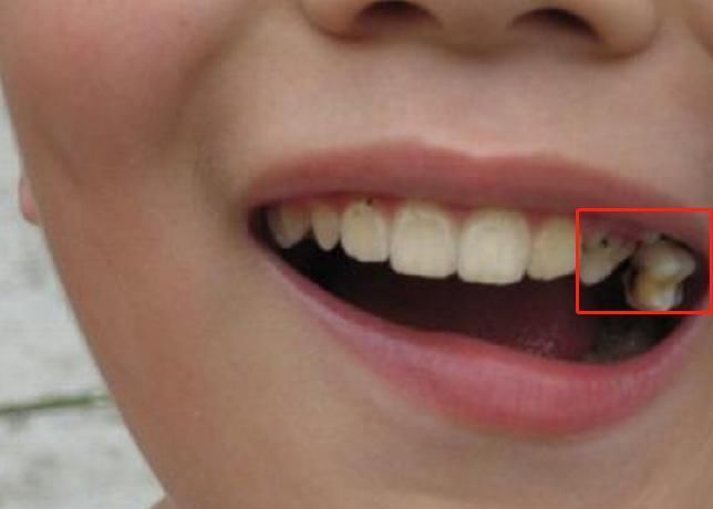 孩子|6岁男娃长“双层牙”,老人的“坏习惯”害了娃,你家有这习惯吗