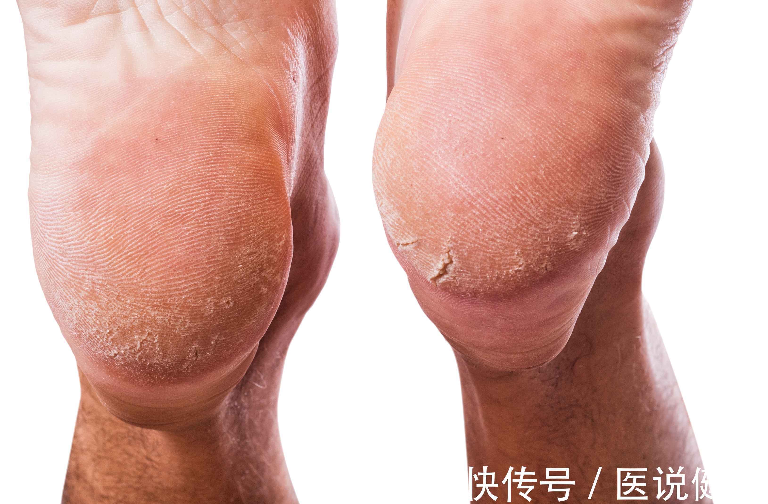 双脚|人老脚先衰?多留意双脚7种表现,若你有,或已进入衰老状态