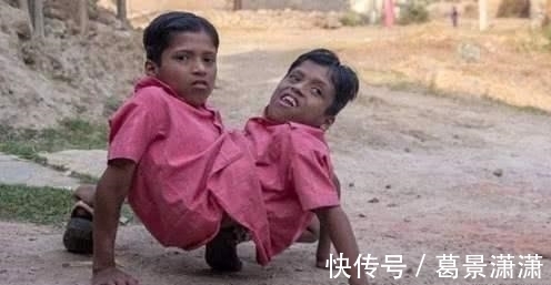 去世|连体人若有一个去世了,另一个会如何?真相让人难以接受!