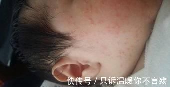 宝宝|湿疹一来百病生,宝宝瘙痒哭闹,温水加一物,皮肤光滑白嫩