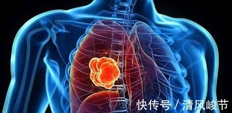 肺癌患者|肺癌若得到控制,先别急着高兴,“危险5年”得做好这3件事