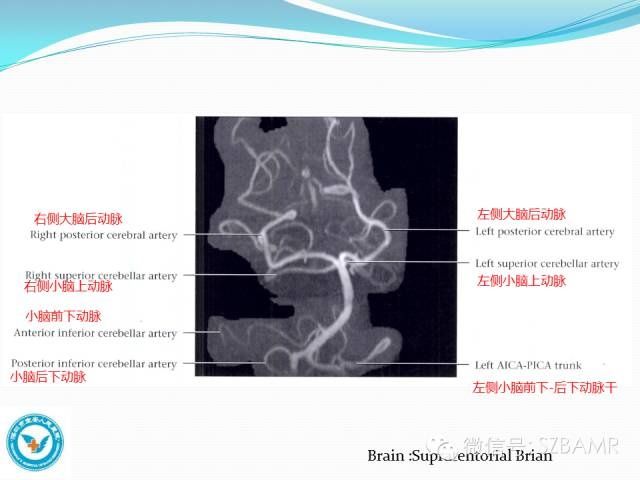 mr|椎-基底动脉系统解剖