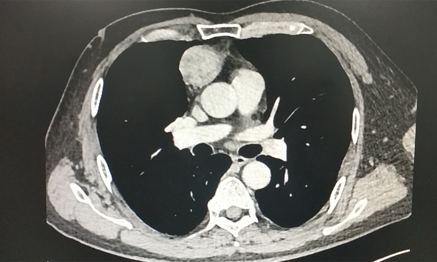 武汉市肺科医院|肺部肿瘤期待手术除病又怕挨刀,医生找到一个不疼的“入胸”通道
