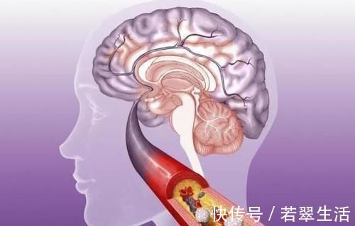 升高|3种调料,正在“偷偷”升高你的血糖,劝告父母,能不放就不放