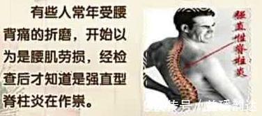强直性脊柱炎|类风湿病痛折磨死人,没有好药医生有!可惜知道的人不多