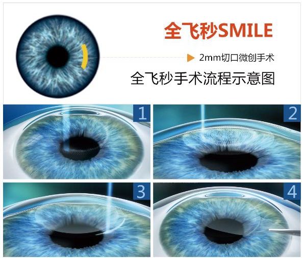 激光打眼那些事儿,近视手术里的“减法手术”|专访济南爱尔眼科刘云川 | 近视手术