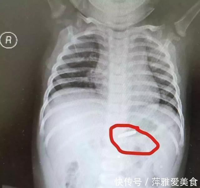异物|小小一枚,孩子喉管被腐蚀!再说一遍,这些东西必须放好了