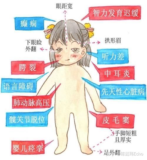 睫毛|宝宝长得太漂亮也是一种病?“歌舞伎综合征”到底是个什么鬼