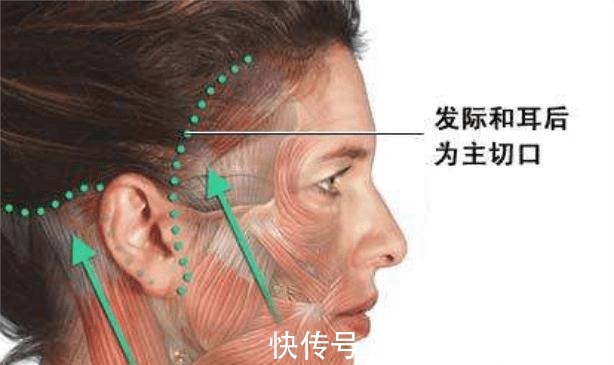 颞部 颞部切口小拉皮术后即刻,老公没找到切口在哪!