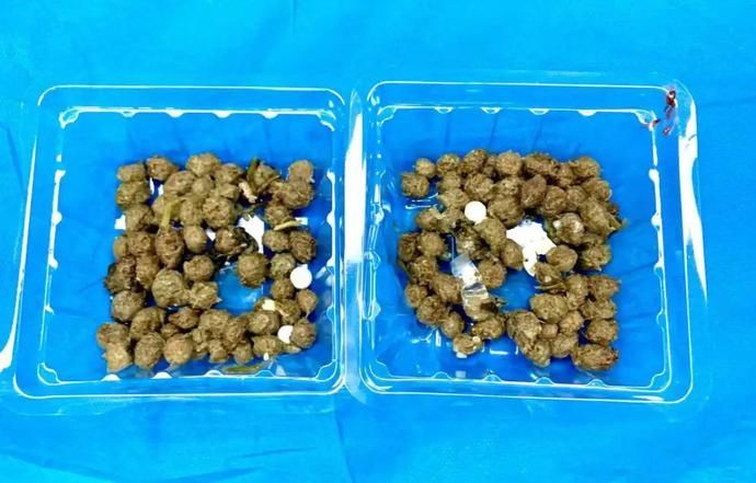 王大伯|悲剧！男子海吃这种正大量上市水果，胃里查出肿瘤！