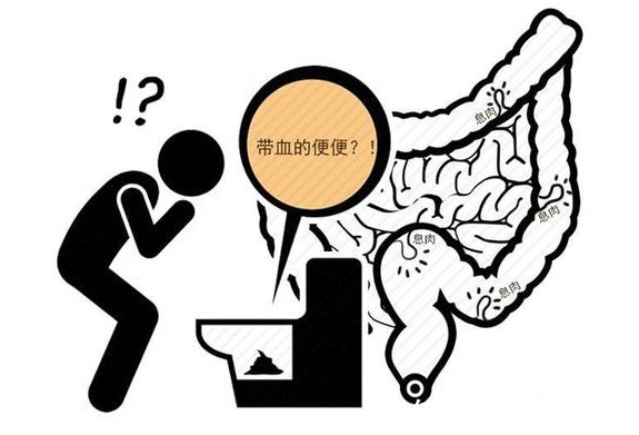 粪便|为何大肠癌多数是晚期才发现？原来上厕所早有征兆，可惜被你忽略