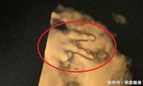 发育|迫不及待想看孩子,四维彩超时宝宝却比个“v”,医生忍不住笑了