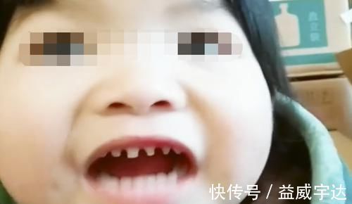医生|2岁宝宝长出“鲨鱼牙”,妈妈慌忙带娃就医,医生:夜奶惹的祸