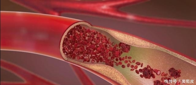47岁男子坚持做二事,甘油三酯从7.6降到1.6,血管通透头不晕