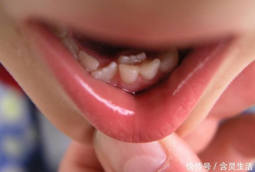 妈妈|4岁孩子一嘴黑牙，妈妈毫不在意认为牙齿能换，牙医叹气无知