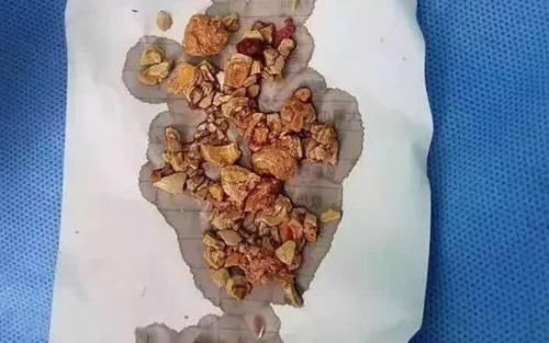 宝妈|4种“毒辅食”喂多了,孩子脾胃就要“罢工”了,尤其是新手宝妈