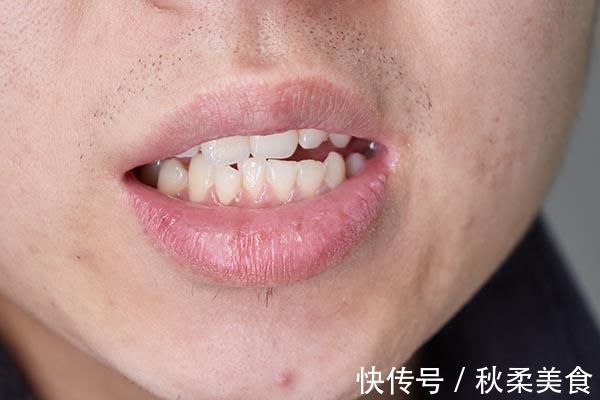 蛀牙|后槽牙上有“黑线”是怎么回事?教你妙招,帮你及时去除