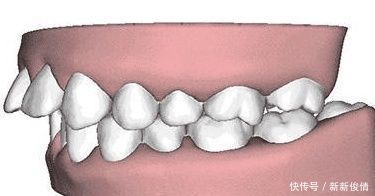 舌头|孩子牙不齐,多半是这4个坏习惯引起的,希望你家孩子一个都没有