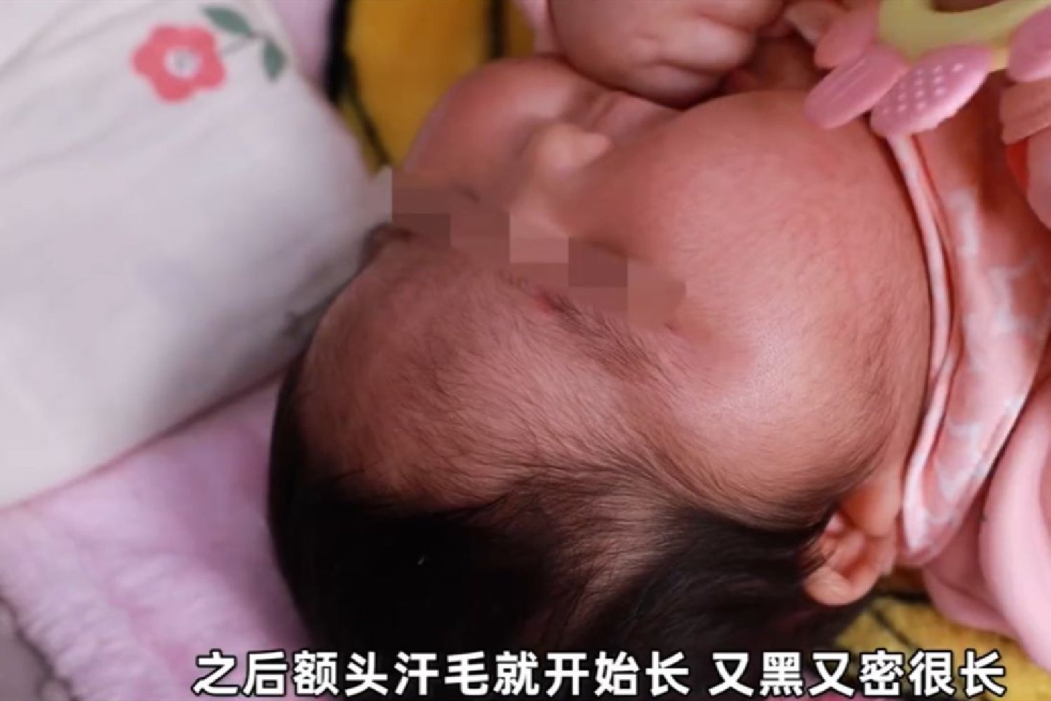 抑菌|“大头娃娃”再现,抑菌霜激素超标,致5个月女婴疯狂长胖长毛