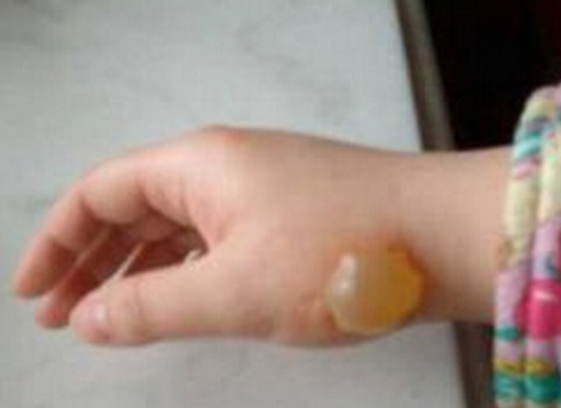 凉水|5岁孙子被开水烫伤,奶奶临危不乱及时处理,获医生称赞 !