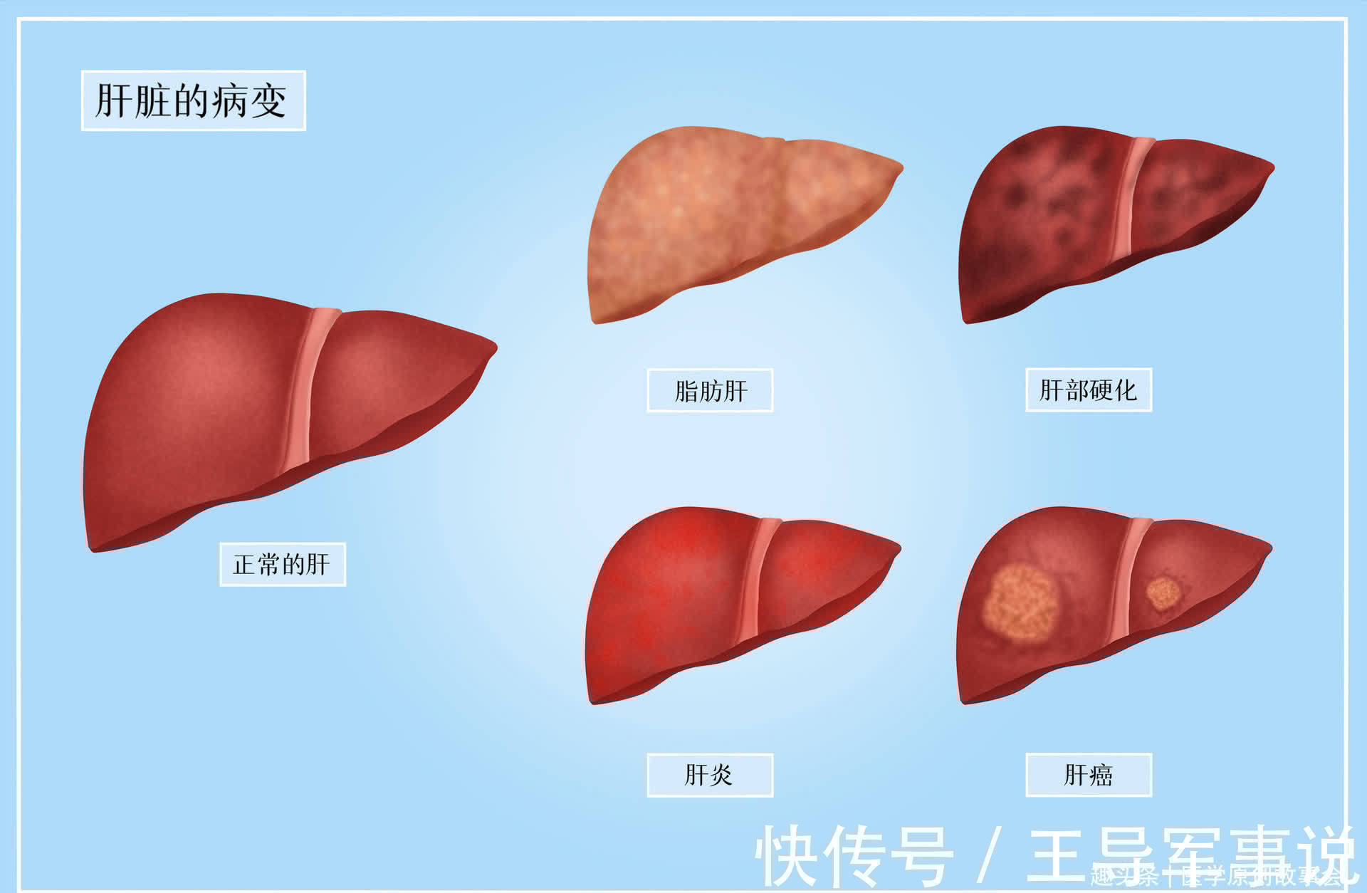 一步之遥|远离肝硬化,请记住,喝酒两不要,晚上两坚持,你的肝脏才会更好