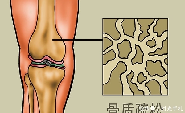 为什么人年纪大了就容易骨折？补充哪些营养，有助养骨？