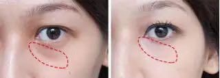 如何区分眼袋、泪沟、卧蚕？