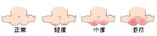 爽身粉|秋季腹泻来临,“红屁屁”找上门?别再用湿巾和爽身粉了,会加重