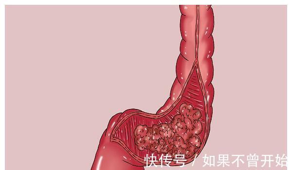 大便|一天发现3例晚期肠癌，医生很痛心，告诉大家：肠癌其实最好预防