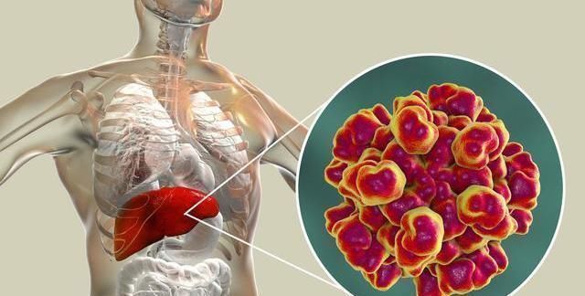 大便|肝癌的“天敌”找到了,不是猪肝和猪血,没事经常喝,肝逐渐变好