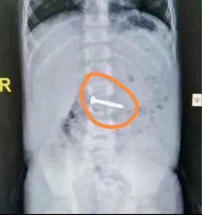 江门|惊险！江门一近两岁宝宝误吞4厘米螺丝钉！不幸中的万幸是……