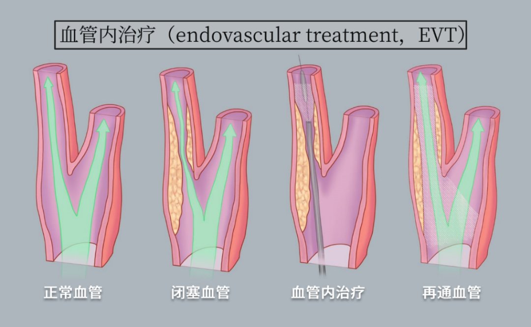 血管|高危非急性颈内动脉闭塞血管内治疗的研究进展