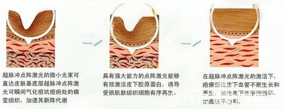 痤疮 怎么去痘|日常战痘还不够,4种医美光电项目来帮你get干净皮肤!