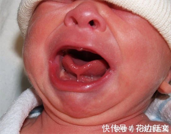 剪舌|滥用的“剪舌系带”，舌系带到底该不该剪？这一刀孩子挨得很无辜