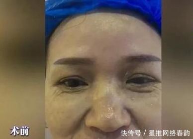 效果|长沙女子花费2万元去皱,结果法令纹依旧,院方:效果因人而异