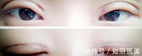 肉条 做双眼皮手术很有可能会产生肉条？你还是会割双眼皮吗