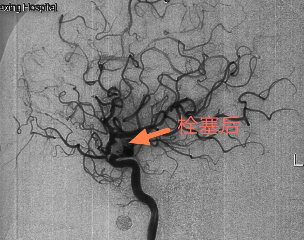 脑动脉瘤|头晕欲裂揪出颅内动脉瘤医生极限“拆弹”化险为夷