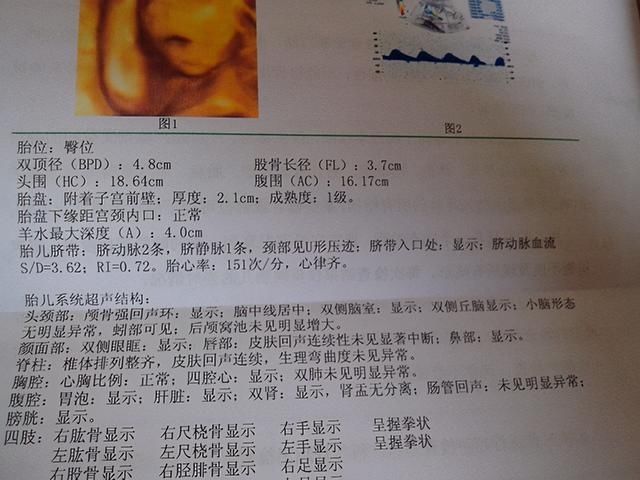 产检|宝宝只有6斤,却因产检时医生的误判,导致本想顺产只好选择剖腹