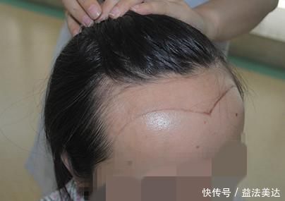 21岁女大学生脱发,惨遭谢顶,提醒:一种水少喝,不然早晚要光头