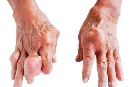 多喝|此物是尿酸的“小冤家”，多喝一点尿酸会多降一点，希愿你早清楚